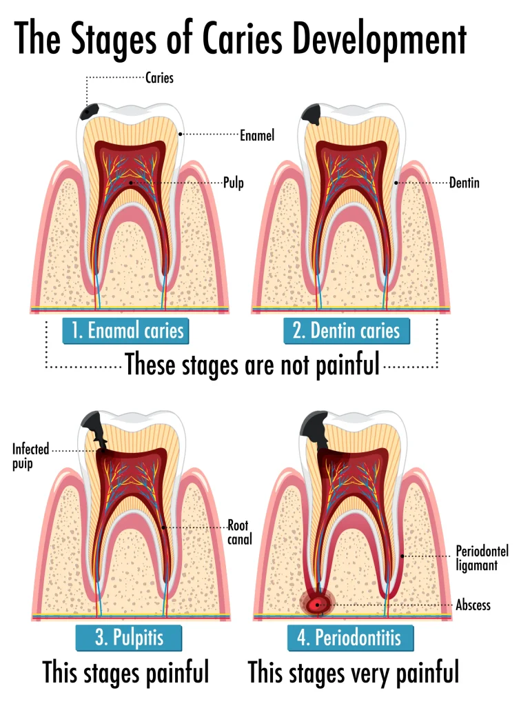 Infographic of human in stages of caries development