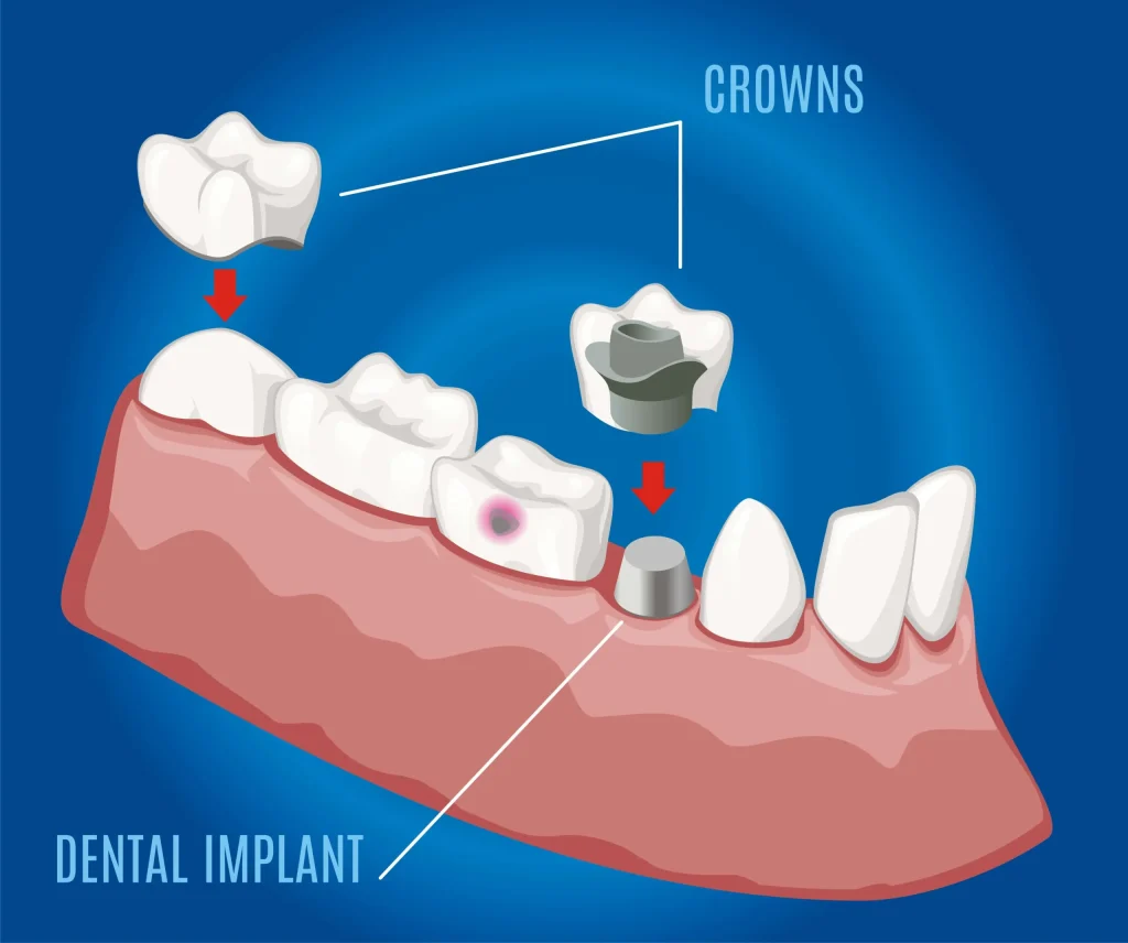 dental-implant-blog-img dental-implant-blog-img