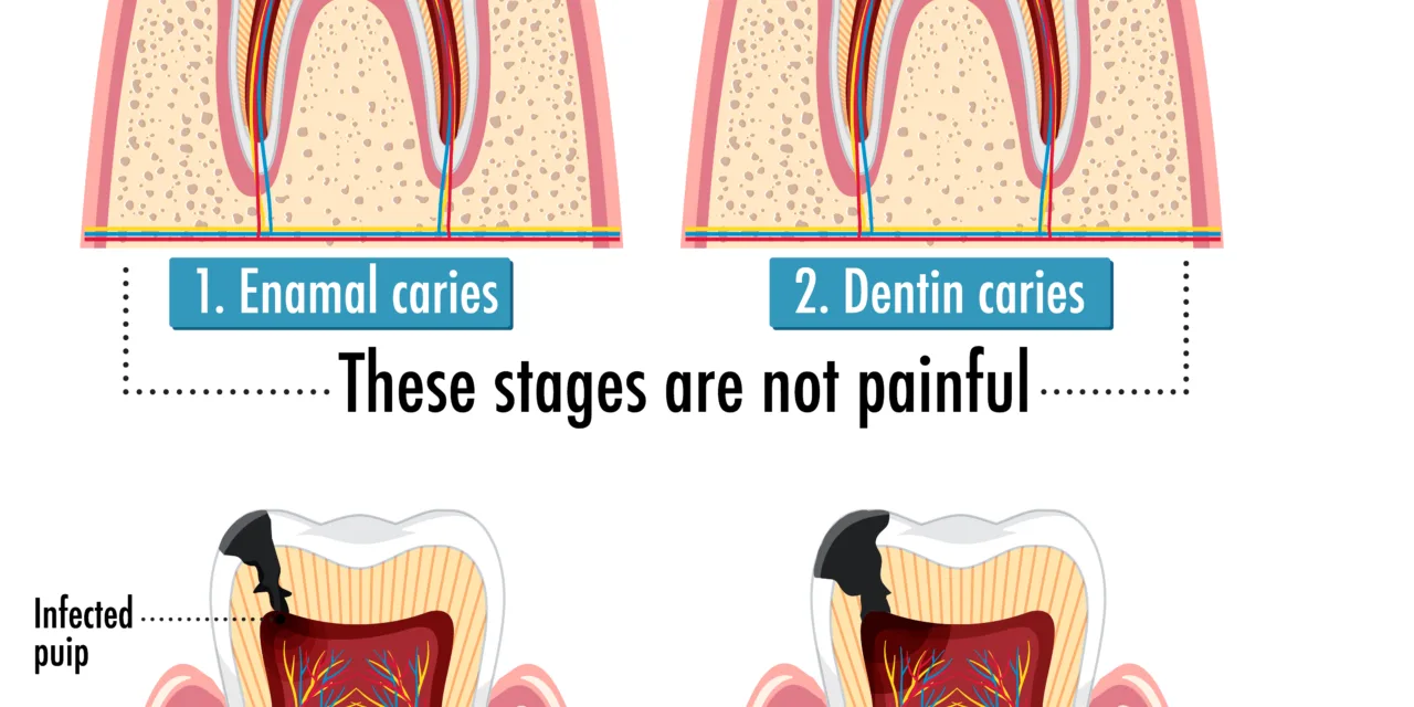 Root Canal Treatment in Riqqah District (الرقة)