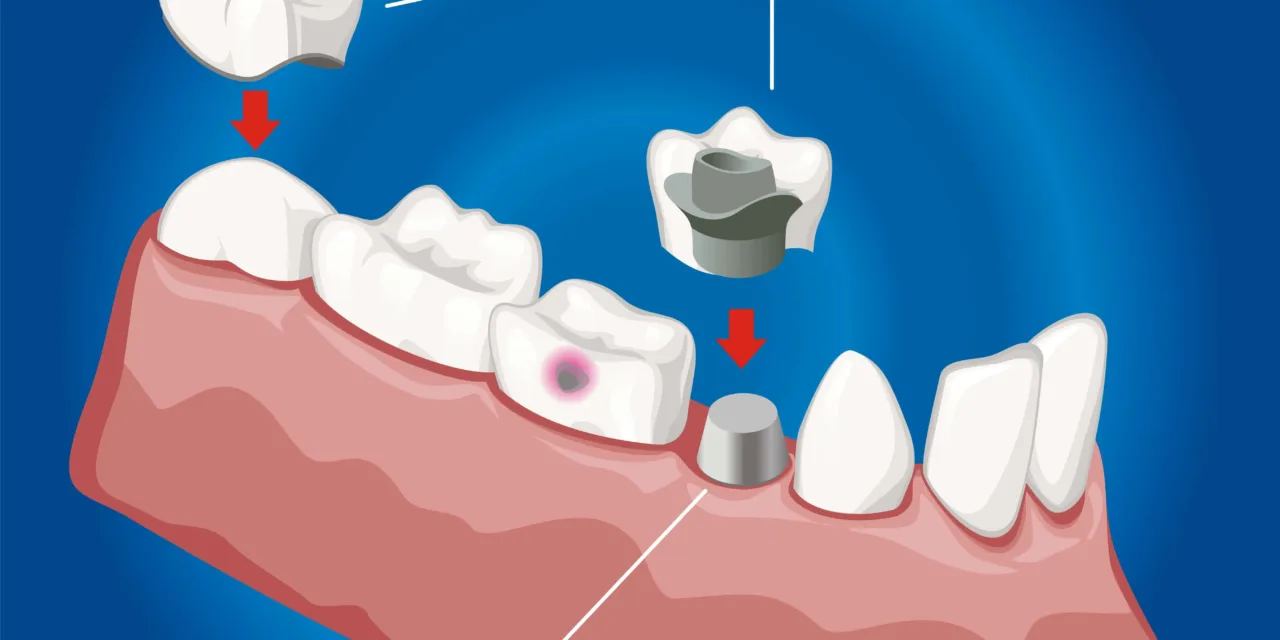 Dental Crowns & Bridges in Rai (الري)