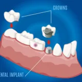 dental-implant-blog-img