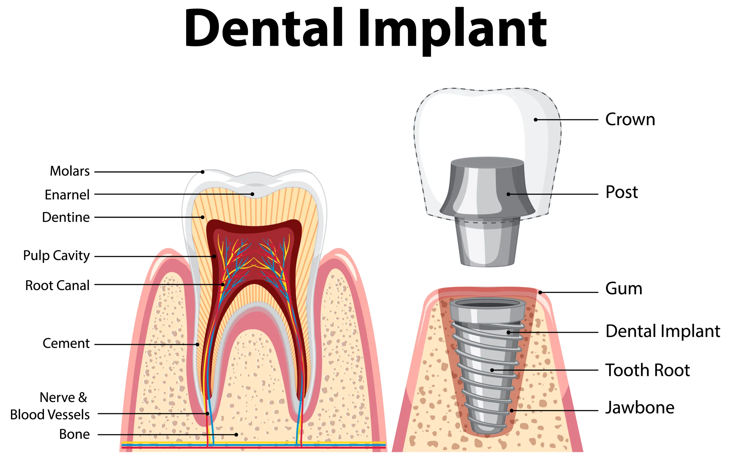 Dental Implants in Surra (السرة)