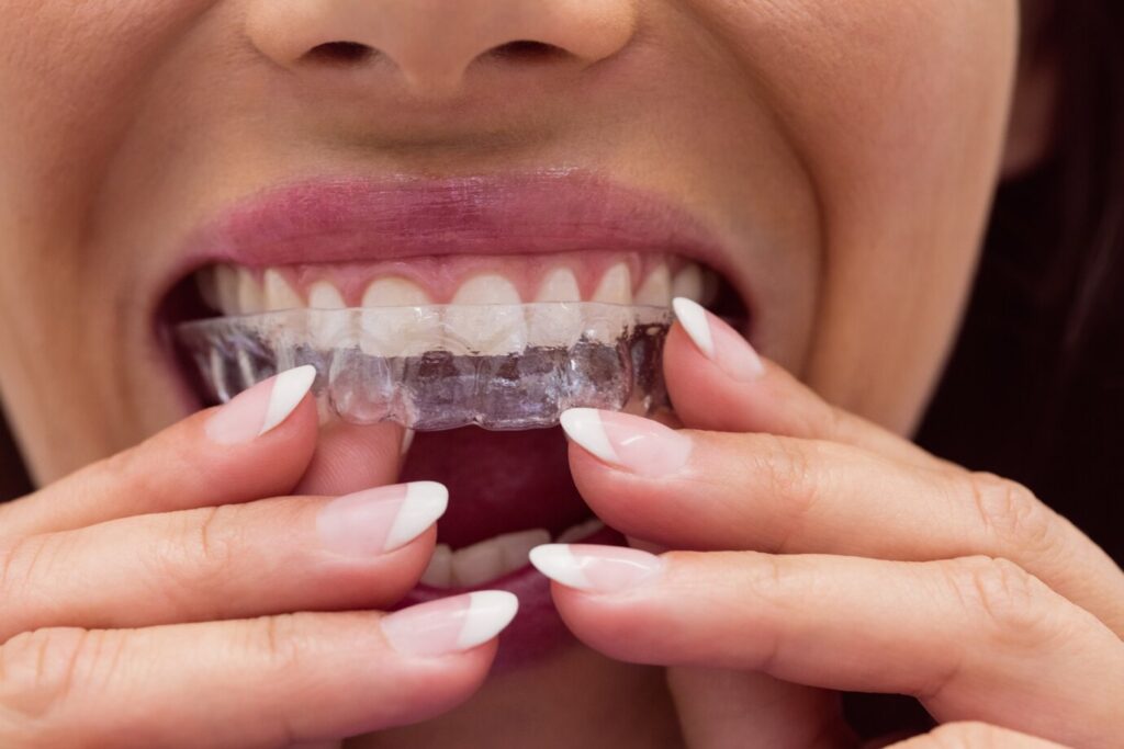 Invisalign In Kuwait