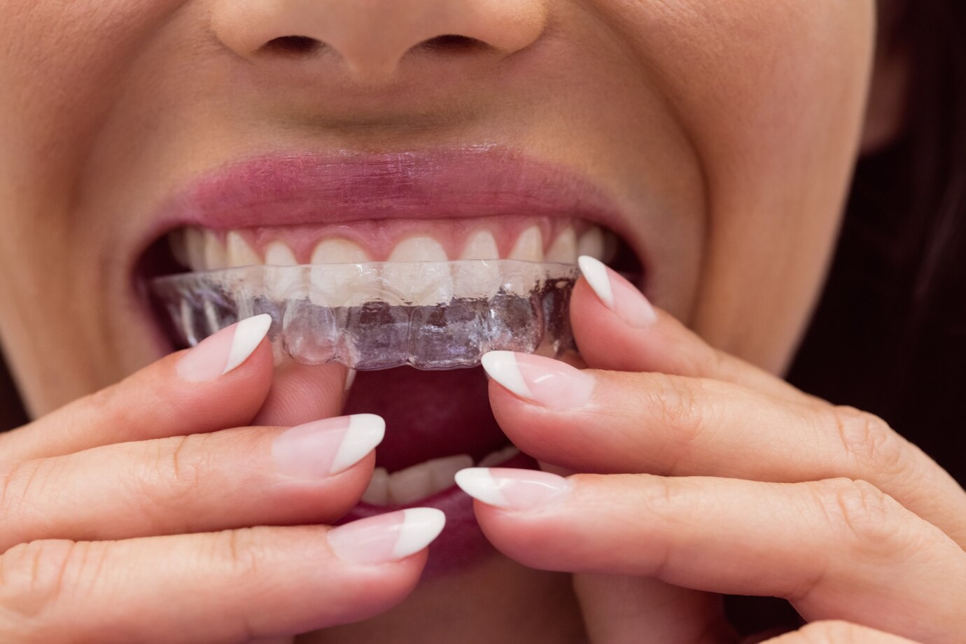 Find the Right Invisalign Dentist for Your Perfect Smile