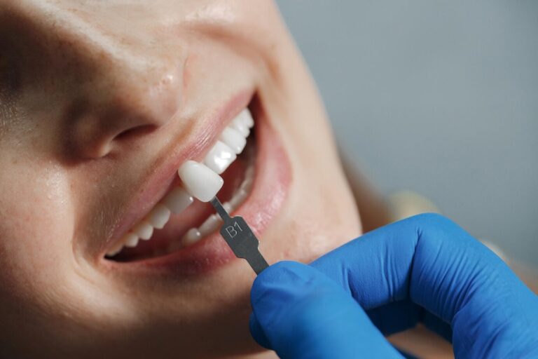 Get Dental Veneers With Chic