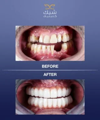 Dental Implants