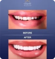 Dental Veneers