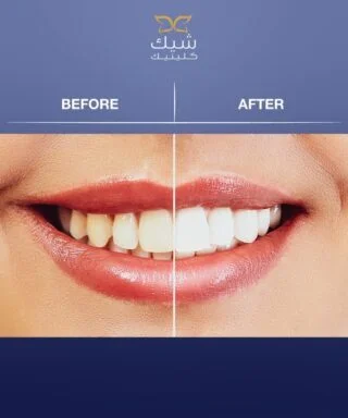 Teeth Whitening