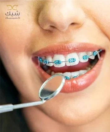 كيف غير تقويم الأسنان الشفاف حياة مرضانا في شيك كلينيك؟