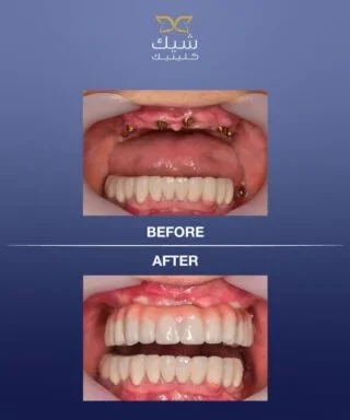 زراعة الأسنان