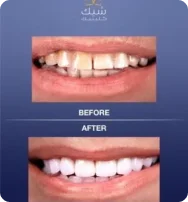 لماذا تعتبر التكنولوجيا الرقمية ضرورية عند تصميم قشور الأسنان الخاصة بك؟